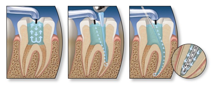 Root-canal-Treatment-in-nagpur
