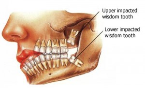 wisdom-tooth-surgery-nagpur
